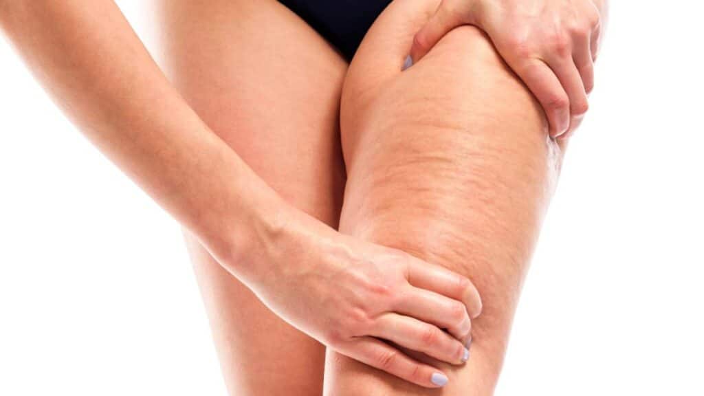 Qué es y cómo eliminar la celulitis 1 pierna celulitis